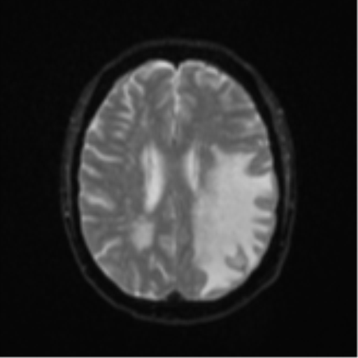File:Cerebral metastasis (Radiopaedia 46744-51248 Axial DWI 18).png