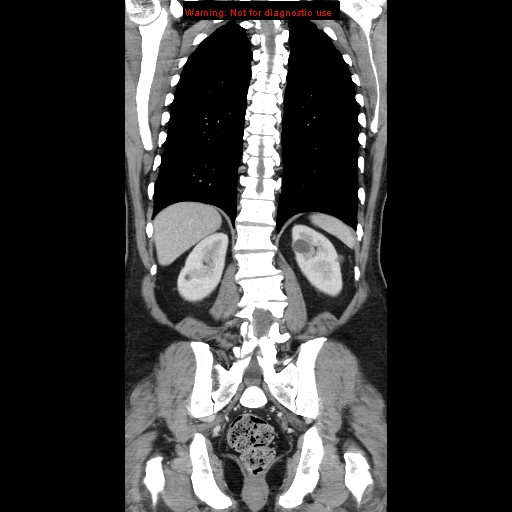 File:Cerebral metastasis - colorectal carcinoma (Radiopaedia 8581-83548 A 61).jpg