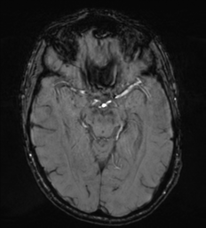 File:Cerebral metastasis - melanoma (Radiopaedia 54718-60954 Axial SWI 23).png