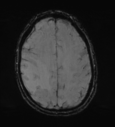 Cerebral metastasis - melanoma (Radiopaedia 54718-60954 Axial SWI 42).png