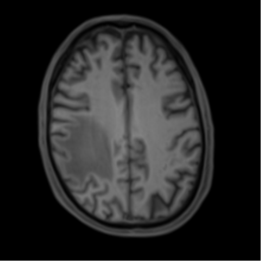 Cerebral metastasis - melanoma (Radiopaedia 54718-60954 Axial T1 37).png