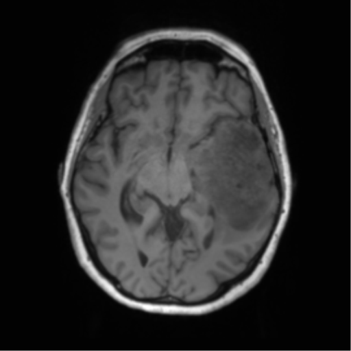 File:Cerebral metastasis mimicking glioblastoma (Radiopaedia 69155-78937 Axial T1 27).png