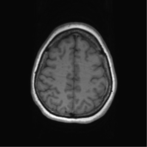 Cerebral metastasis mimicking glioblastoma (Radiopaedia 69155-78937 Axial T1 53).png