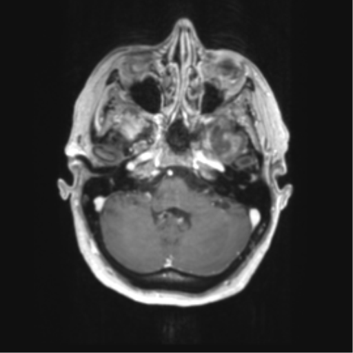 Cerebral metastasis mimicking glioblastoma (Radiopaedia 69155-78937 Axial T1 C+ 11).png