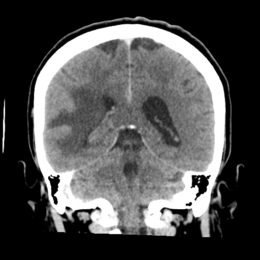 Cerebral metastasis to basal ganglia (Radiopaedia 81568-95412 Coronal C+ delayed 41).png