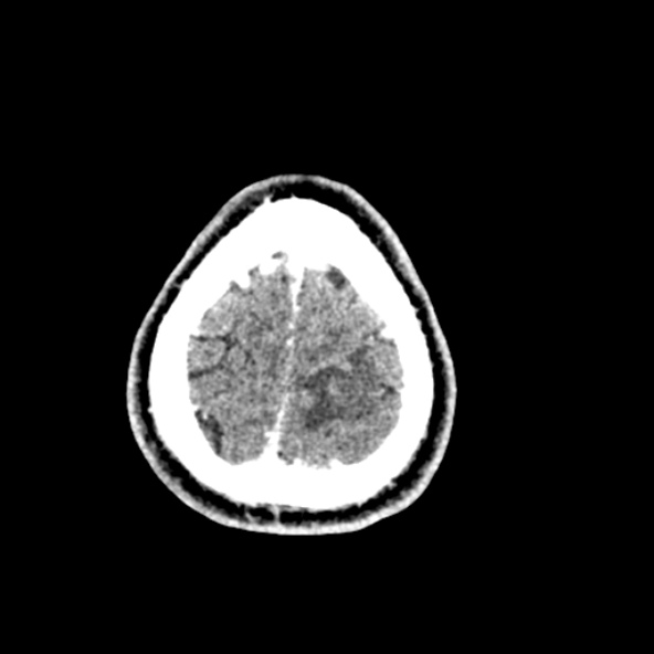 Cerebral toxoplasmosis (Radiopaedia 53993-60131 Axial C+ delayed 67).jpg