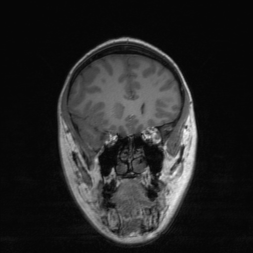 Cerebral tuberculosis with dural sinus invasion (Radiopaedia 60353-68090 Coronal T1 60).jpg