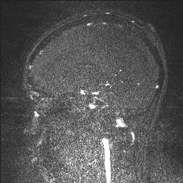 Cerebral tuberculosis with dural sinus invasion (Radiopaedia 60353-68090 Sagittal MRV 89).jpg