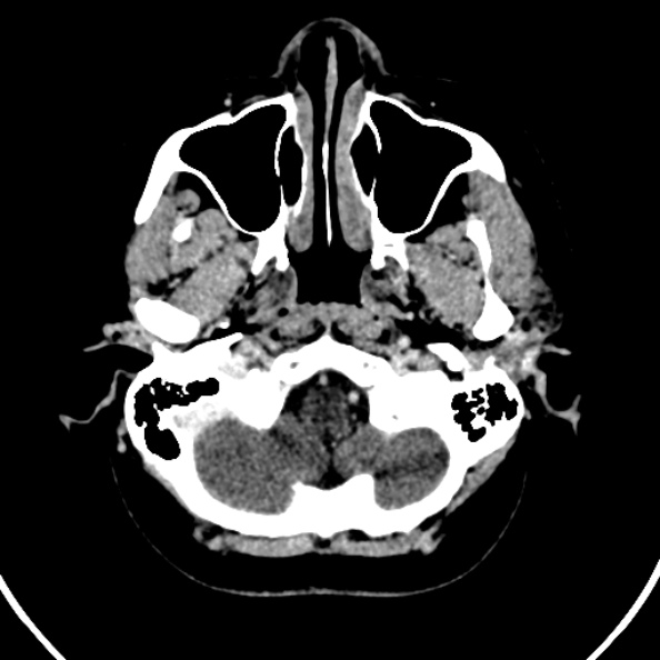 Cerebral venous hemorrhagic infarct from venous sinus thrombosis (Radiopaedia 55433-61883 Axial C+ delayed 132).jpg