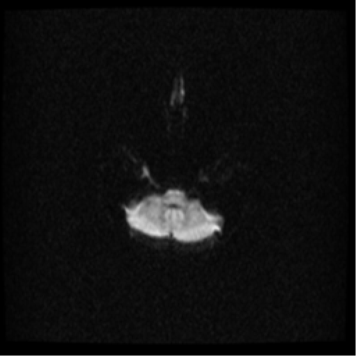 File:Cerebral venous hemorrhagic infarction (Radiopaedia 38461-40552 Axial DWI 11).png
