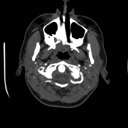 Cerebral venous sinus thrombosis (Radiopaedia 40619-43227 A 8).jpg
