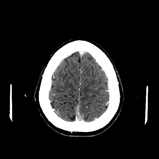 File:Cerebral venous thrombosis (CVT) (Radiopaedia 77524-89685 Axial with contrast 32).jpg