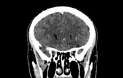 Cerebral venous thrombosis (CVT) (Radiopaedia 77524-89685 C 18).jpg