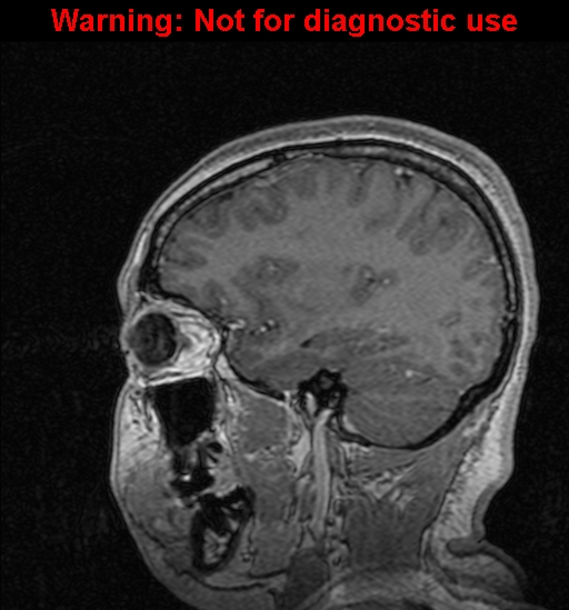 File:Cerebral venous thrombosis (Radiopaedia 37224-39208 Sagittal T1 C+ 45).jpg