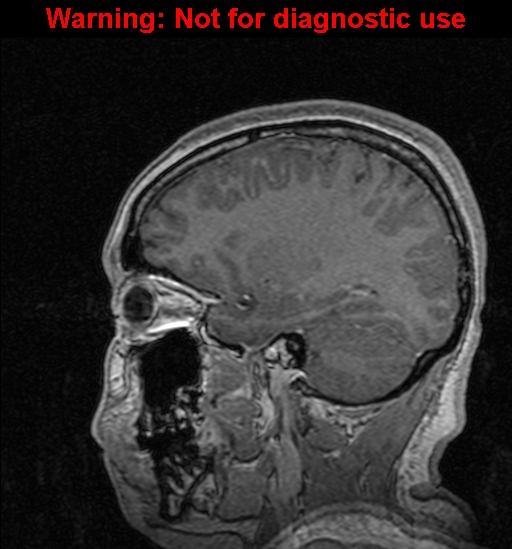 File:Cerebral venous thrombosis (Radiopaedia 37224-39208 Sagittal T1 C+ 50).jpg