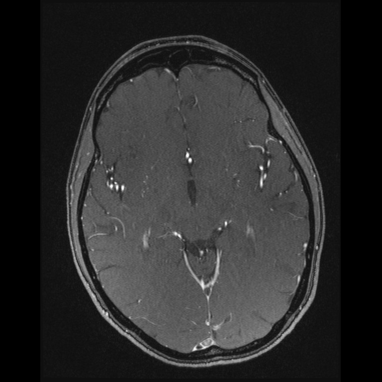 Cerebral venous thrombosis (Radiopaedia 45678-49854 Axial MRV 33).jpg
