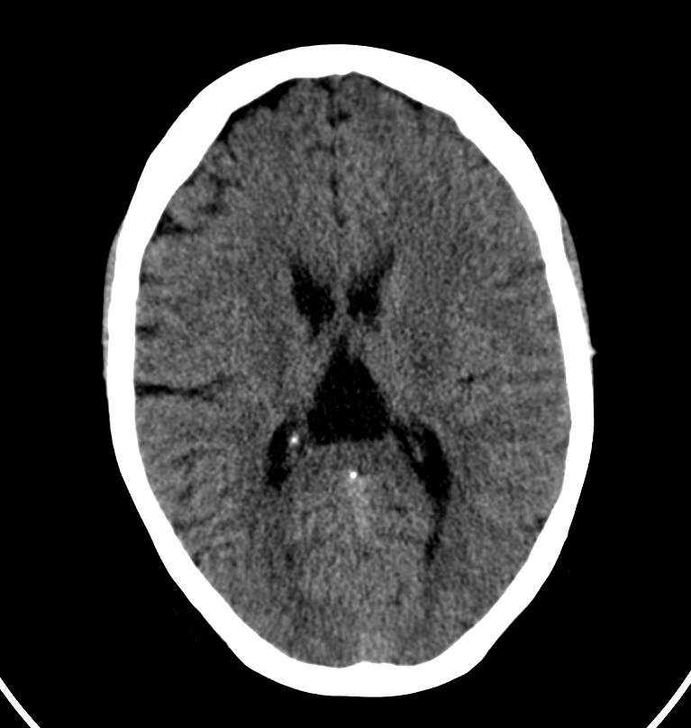 Cerebral venous thrombosis - CT only (Radiopaedia 41031-43778 Axial non-contrast 36).jpg