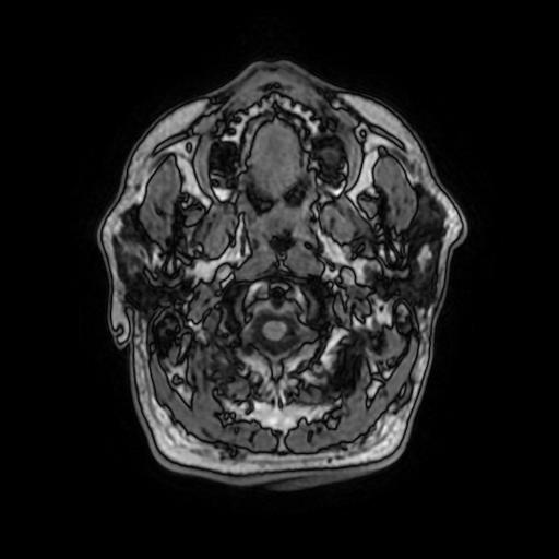 File:Cerebral venous thrombosis with secondary intracranial hypertension (Radiopaedia 89842-106957 Axial T1 27).jpg