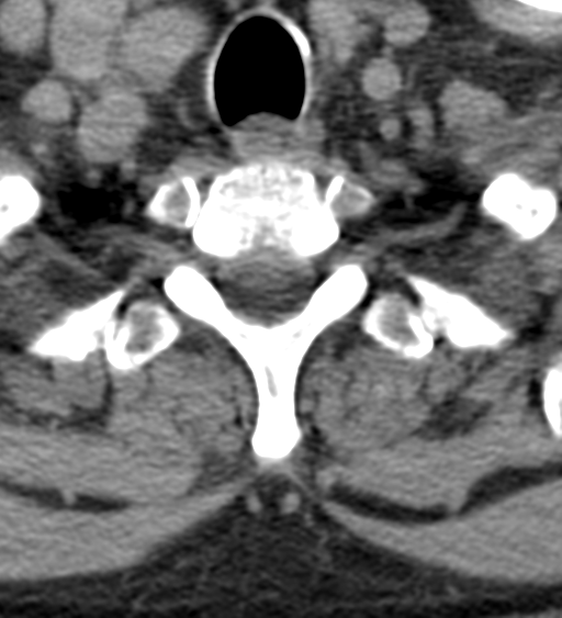 File:Cervical canal stenosis due to ossification of the posterior longitudinal ligament (Radiopaedia 47260-51823 Axial non-contrast 55).png
