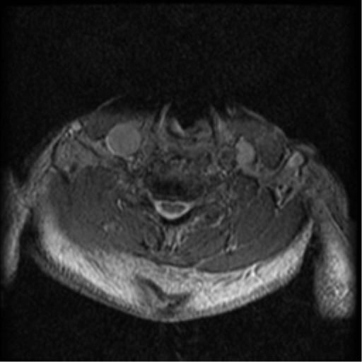 Cervical canal stenosis with cord compression (Radiopaedia 34114-35374 Axial Gradient Echo 33).png