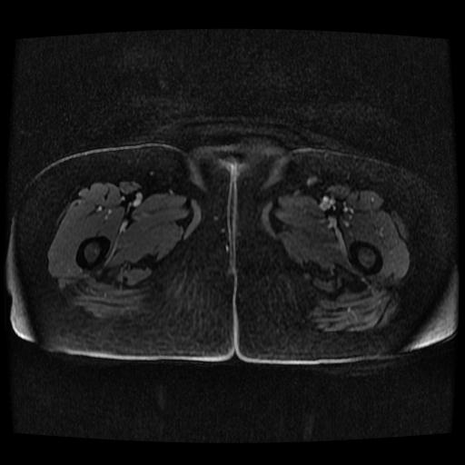 Cervical carcinoma (Radiopaedia 70924-81132 Axial T1 C+ fat sat 96).jpg