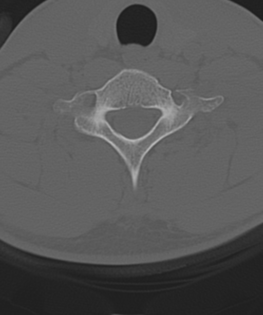 Cervical intercalary bone (Radiopaedia 35211-36748 Axial bone window 51).png