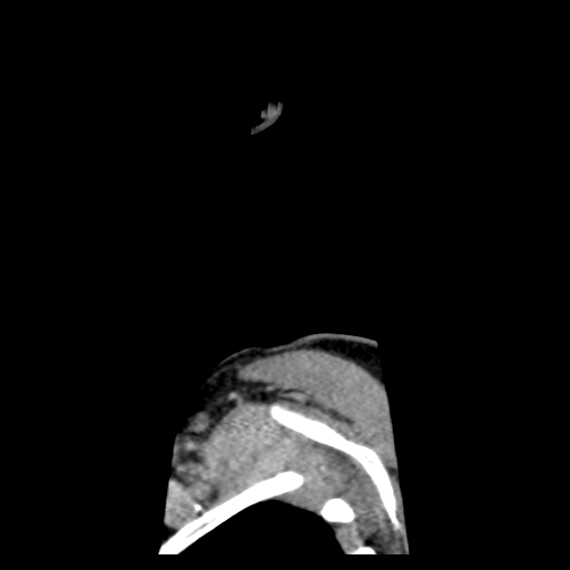 Cervical schwannoma (Radiopaedia 57979-64974 H 64).png