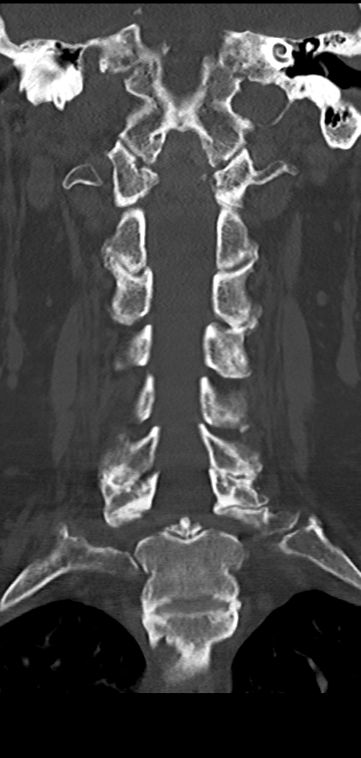 Cervical spine fracture - chalk stick (Radiopaedia 39116-41323 Coronal bone window 26).png
