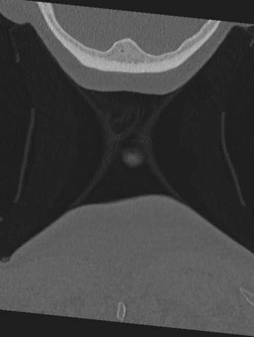 Cervical spondylolysis (Radiopaedia 49616-54811 Coronal bone window 74).png