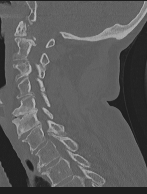 Cervical spondylolysis (Radiopaedia 49616-54811 Sagittal bone window 43).png