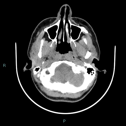 Cervical thymic cyst (Radiopaedia 88632-105335 Axial non-contrast 102).jpg