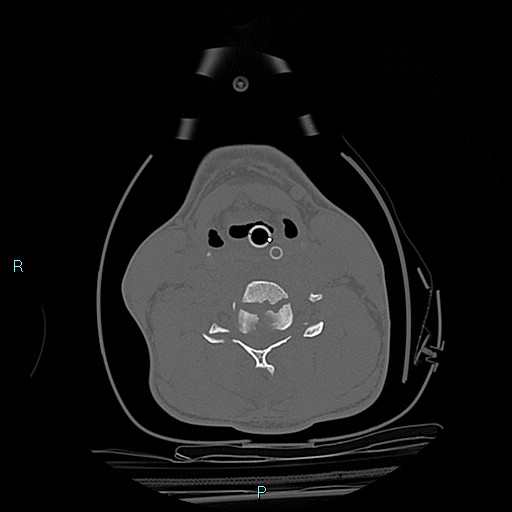 File:Cervical vertebral burst fracture (Radiopaedia 37420-39258 Axial bone window 21).jpg