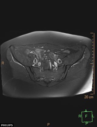 File:Cesarian scar endometriosis (Radiopaedia 68495-78066 Axial T1 C+ fat sat 5).jpg