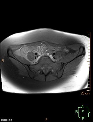 File:Cesarian scar endometriosis (Radiopaedia 68495-78066 Axial T1 fat sat 2).jpg