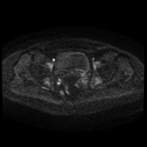 Cesarian section scar endometriosis (Radiopaedia 66520-75799 Axial DWI 93).jpg