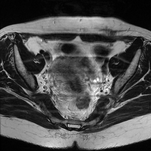 File:Cesarian section scar endometriosis (Radiopaedia 66520-75799 Axial T2 9).jpg