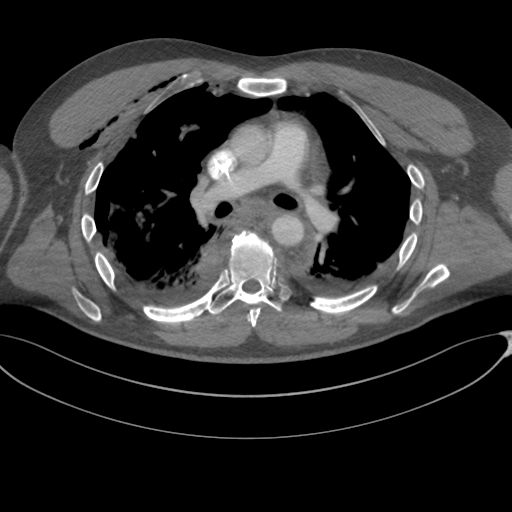 File:Chest multitrauma - aortic injury (Radiopaedia 34708-36147 A 133).png