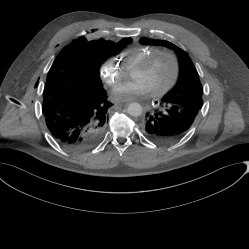 File:Chest multitrauma - aortic injury (Radiopaedia 34708-36147 A 186).png