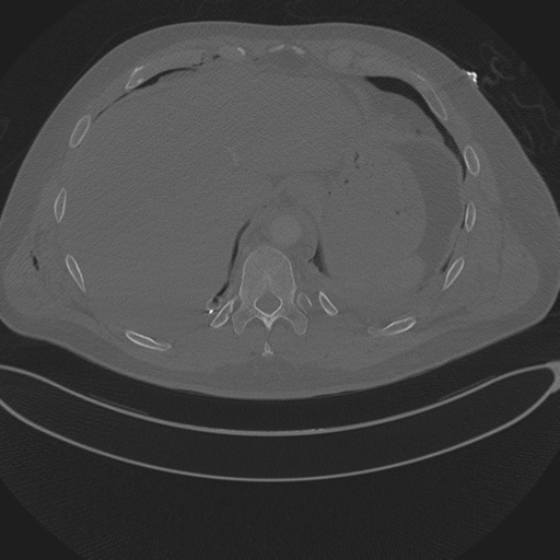File:Chest multitrauma - aortic injury (Radiopaedia 34708-36147 Axial bone window 256).png