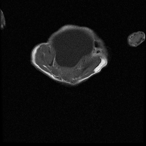 File:Chiari II malformation with spinal meningomyelocele (Radiopaedia 23550-23652 Axial T1 17).jpg