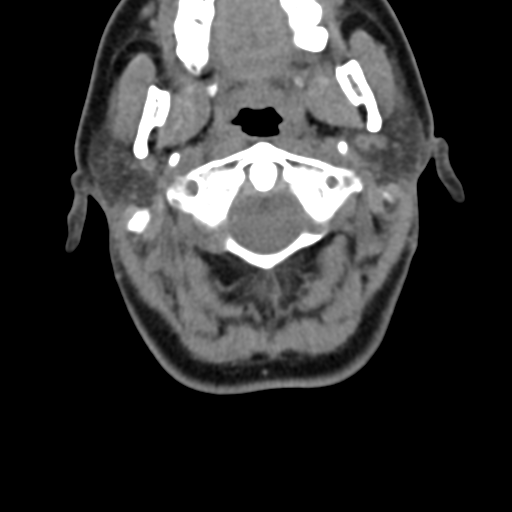 Chiari I malformation and obstructive hydrocephalus (Radiopaedia 41185-43981 D 34).png