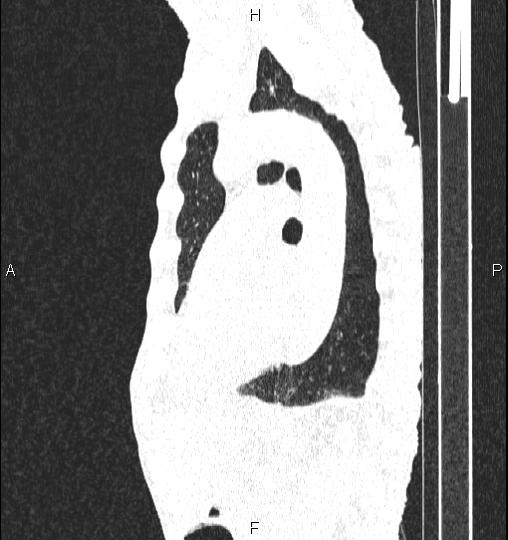 Chilaiditi sign (Radiopaedia 88839-105611 Sagittal lung window 59).jpg
