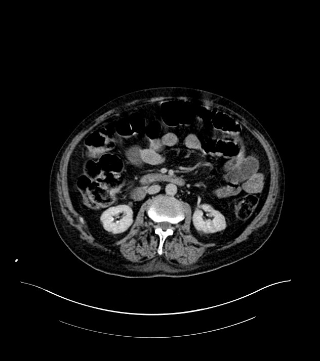 Cholangiocarcinoma with cerebral metastases (Radiopaedia 83519-98629 Axial C+ delayed 54).jpg