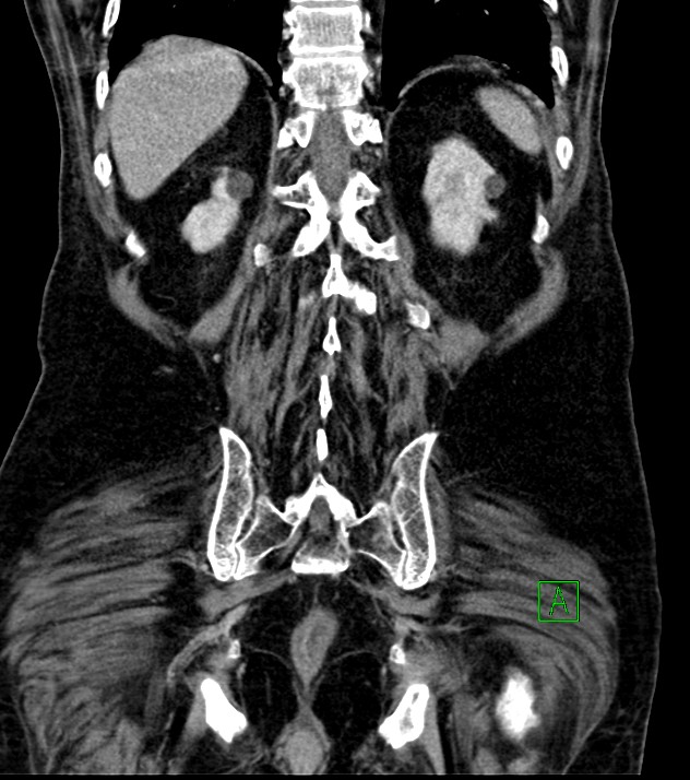 Cholangiocarcinoma with cerebral metastases (Radiopaedia 83519-98629 G 65).jpg