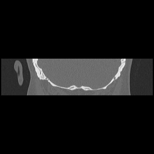 Cholesteatoma (Radiopaedia 84946-100455 Coronal bone window 130).jpg