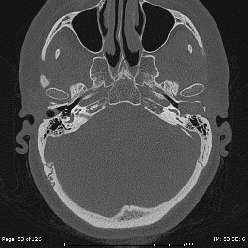Cholesteatoma - external auditory canal (Radiopaedia 88452-105096 Axial bone window 46).jpg