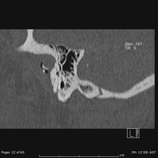 Cholesteatoma - external auditory canal (Radiopaedia 88452-105096 Sagittal bone window 12).jpg