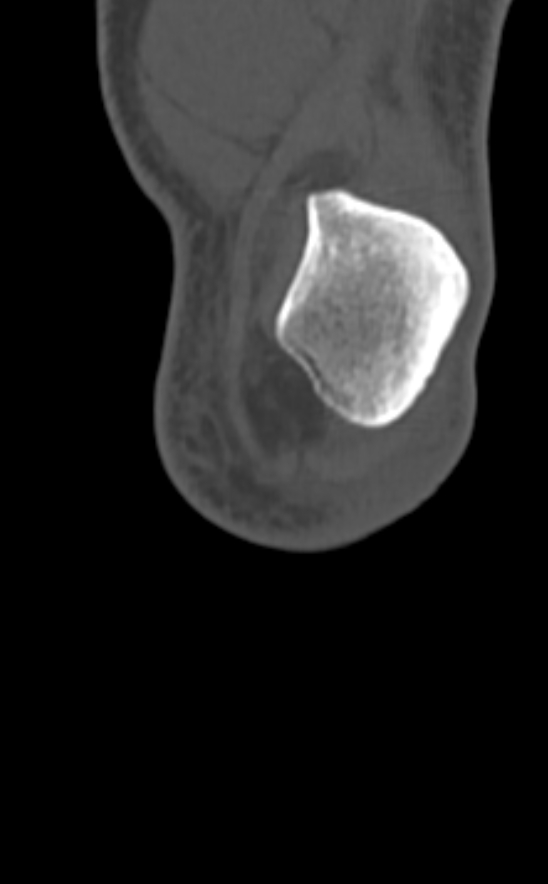 Chondrocalcinosis (Radiopaedia 82862-97173 Coronal bone window 9).jpg