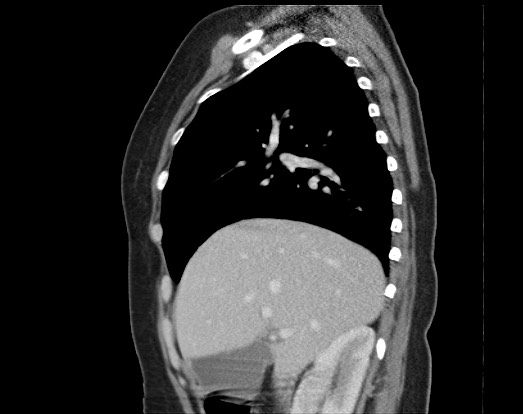 Chondrosarcoma - chest wall (Radiopaedia 65192-74199 B 41).jpg