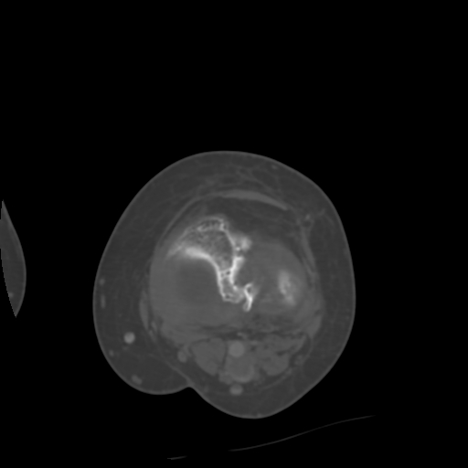 Chondrosarcoma - femur (Radiopaedia 64187-72954 Axial bone window 51).jpg
